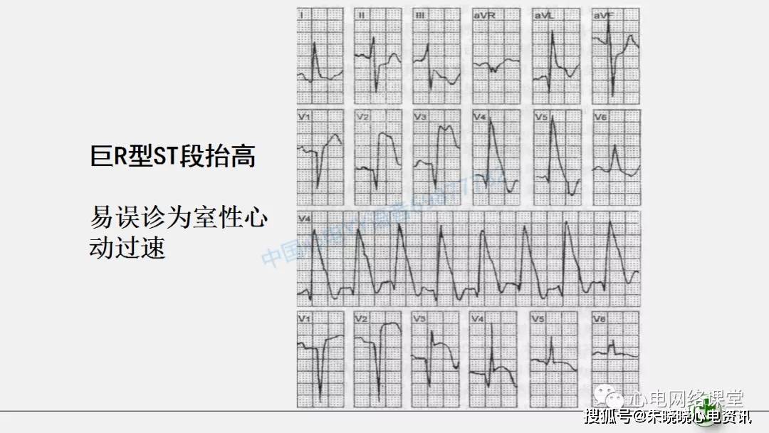 不典型心肌梗死心电图表现