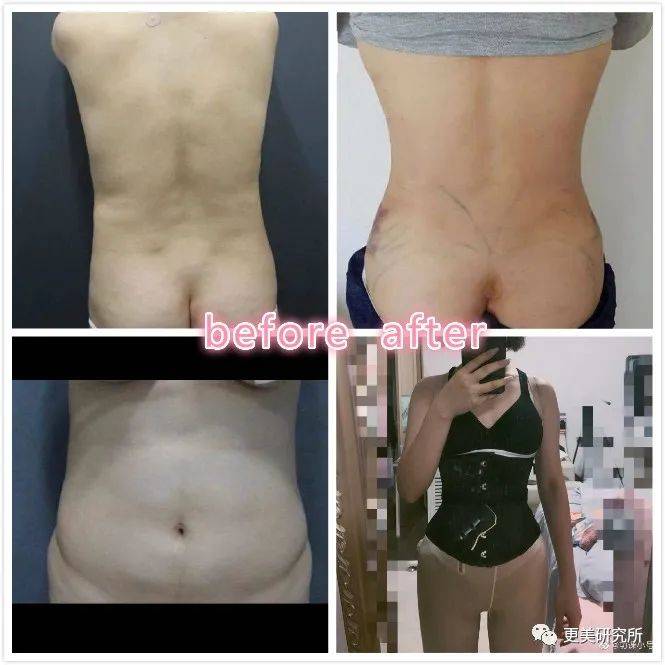 脂肪|鞠婧祎再花70w能do成迪丽热巴的前凸后翘？！