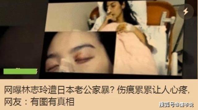 林志玲秘密开刀治旧疾,老公黑泽良平却未踪影
