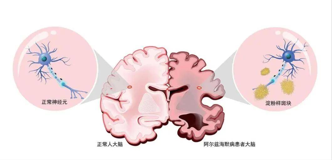 5000万ad人群不再遗忘干细胞有望逆转阿尔茨海默症