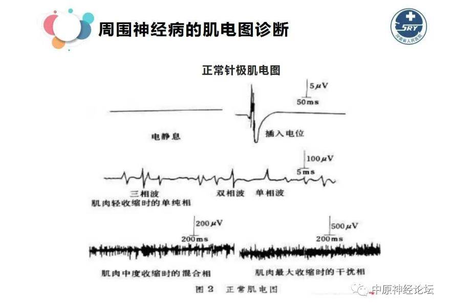 肌电图周围神经病与肌电图诊断