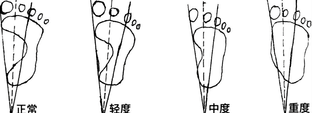 脚背不红不肿痛怎么办