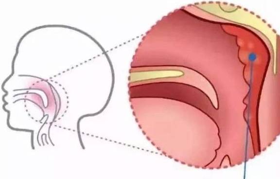 影响|严重时影响孩子智力和颜值孩子打呼噜代表睡得香？别逗了