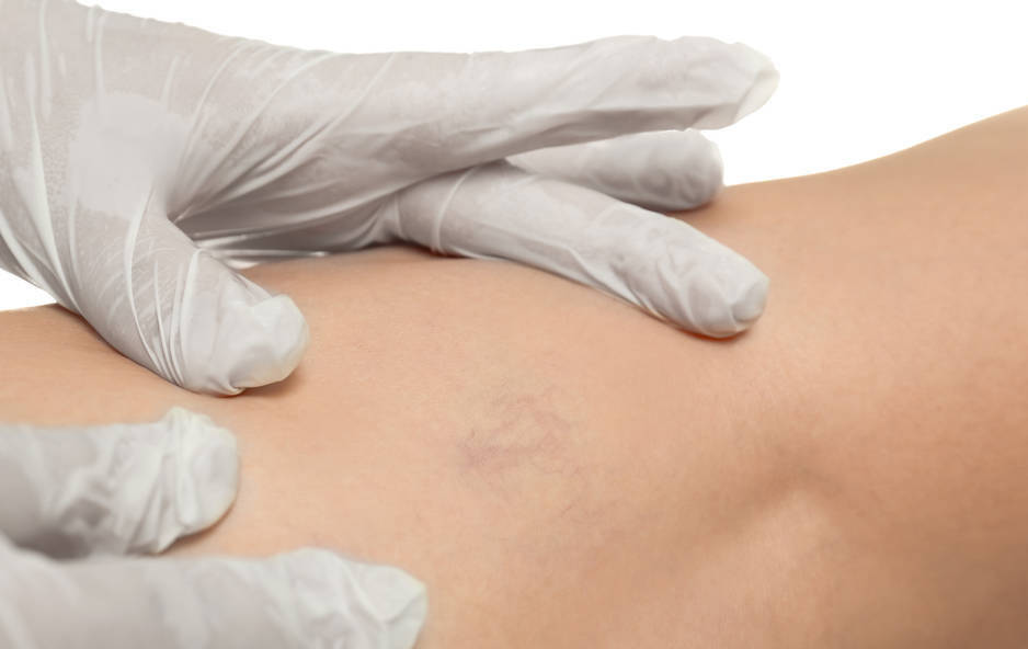 下肢|糖尿病人有水肿，是肾病发生了吗？