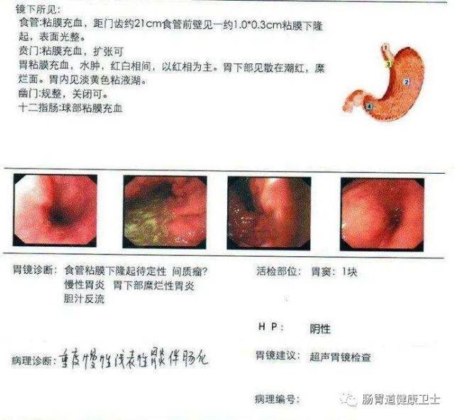 胃炎,胃溃疡,感染幽门螺杆菌,教你3分钟看懂胃镜检查报告