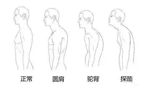 我们常见的驼背是指胸椎部分弧度过大,背部呈现圆弧形.