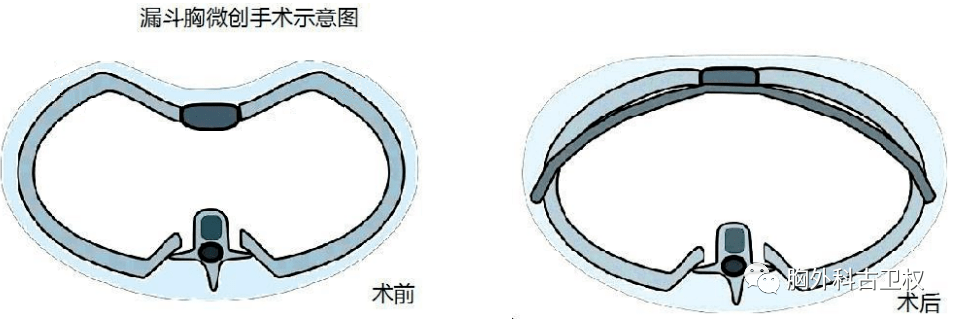 目前国际上流行的nuss手术及改良手术,是目前最成熟的漏斗胸矫正手术.