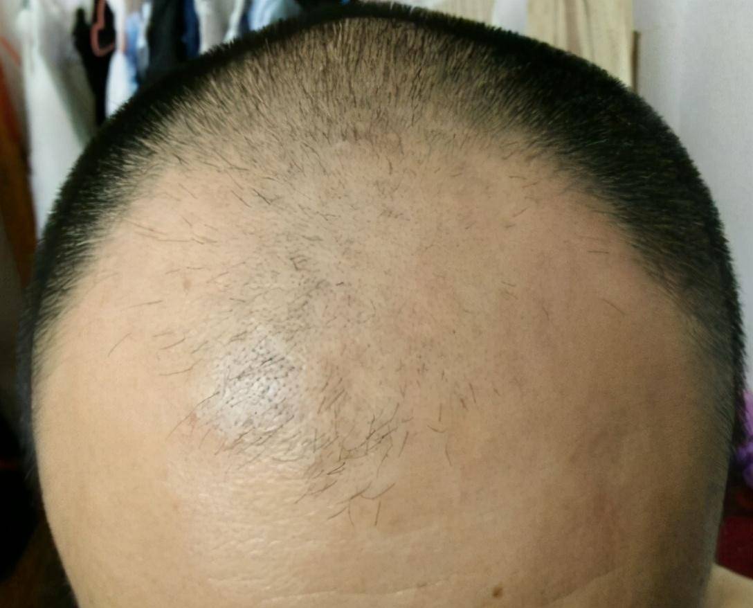 30岁男子脱发十年,尝了数十种生发的办法,但前额还是秃了