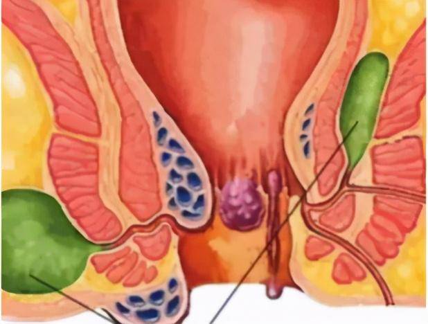 肛周脓肿才是屁股的克星,让你体验到什么叫求生不得求