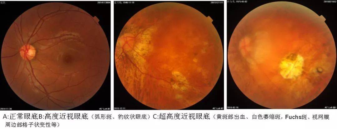 高度近视的人,十年后会发生什么?_眼底