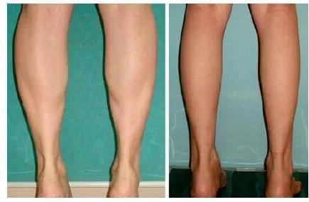 手术|杨幂关晓彤杠上了？撞衫尴尬就算了，还被网友喷做了直腿手术…