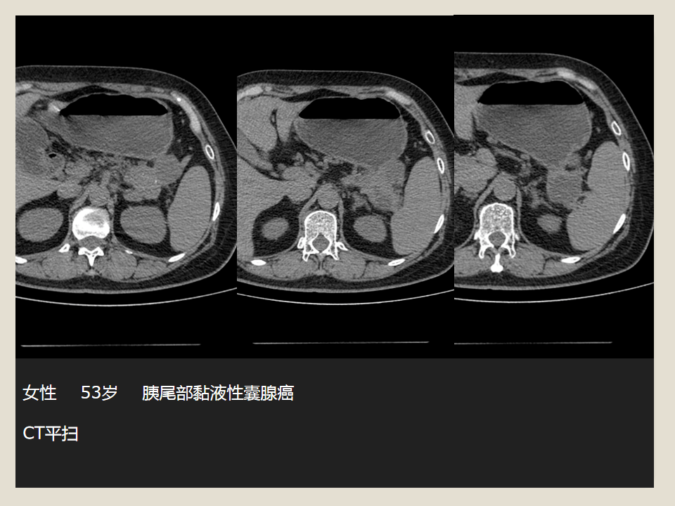 胰腺常见囊性肿瘤的ct表现及鉴别诊断