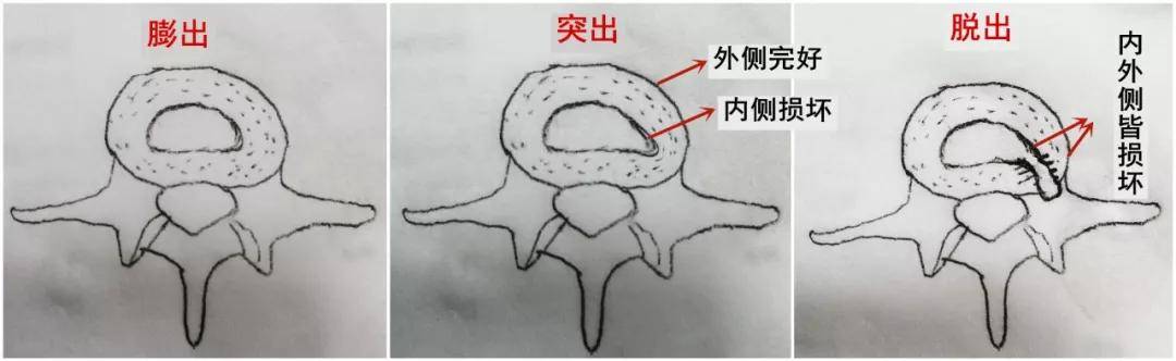 腰椎小关节突出症的症状则是在腰椎过伸,旋转以及体位变化时加重,平