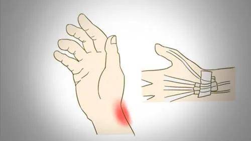 腱鞘炎的症状表现 1 通常在早晨时最容易感觉到手指弯曲不方便,活络