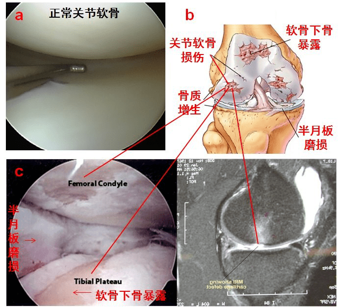 膝关节疼到底是滑膜炎骨质增生关节积液还是关节炎