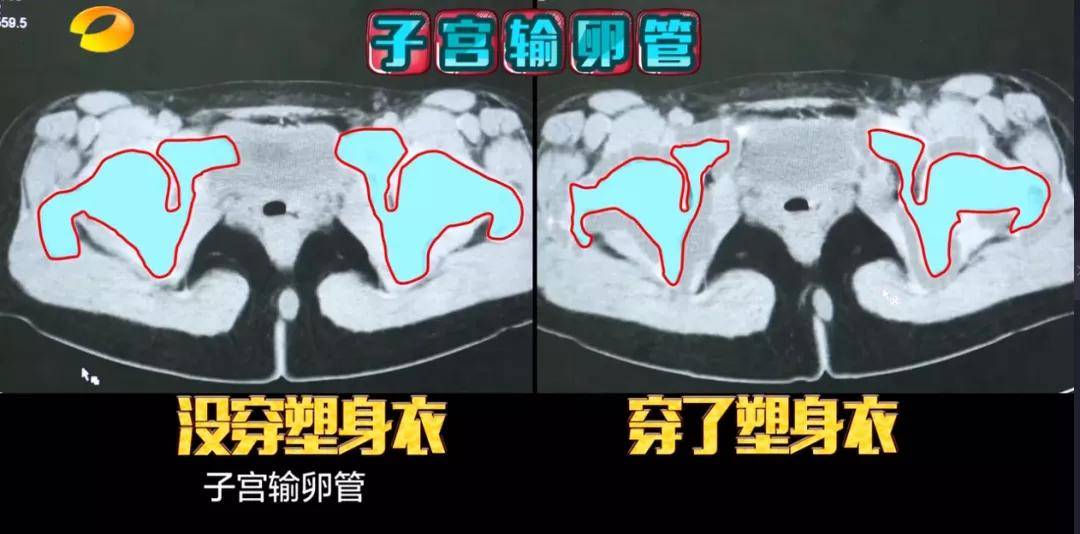 妇科病|“显瘦神器”不用运动，就能马上瘦一圈，你想要不？