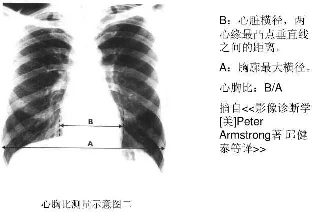 x线中的心影增大怎么解读