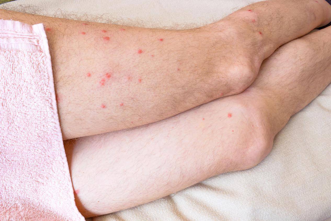 什么原因会引起荨麻疹反复 8a7a0555612b4b52ad28c36f021f5687.jpeg