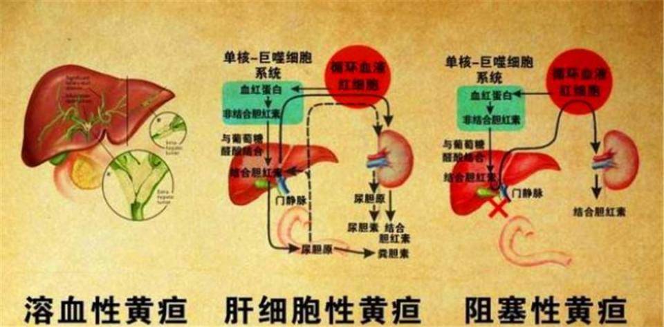 肝外胆汁淤积又称为梗阻性黄疸,可由于胆总管结石,狭窄,炎症水肿,肿瘤