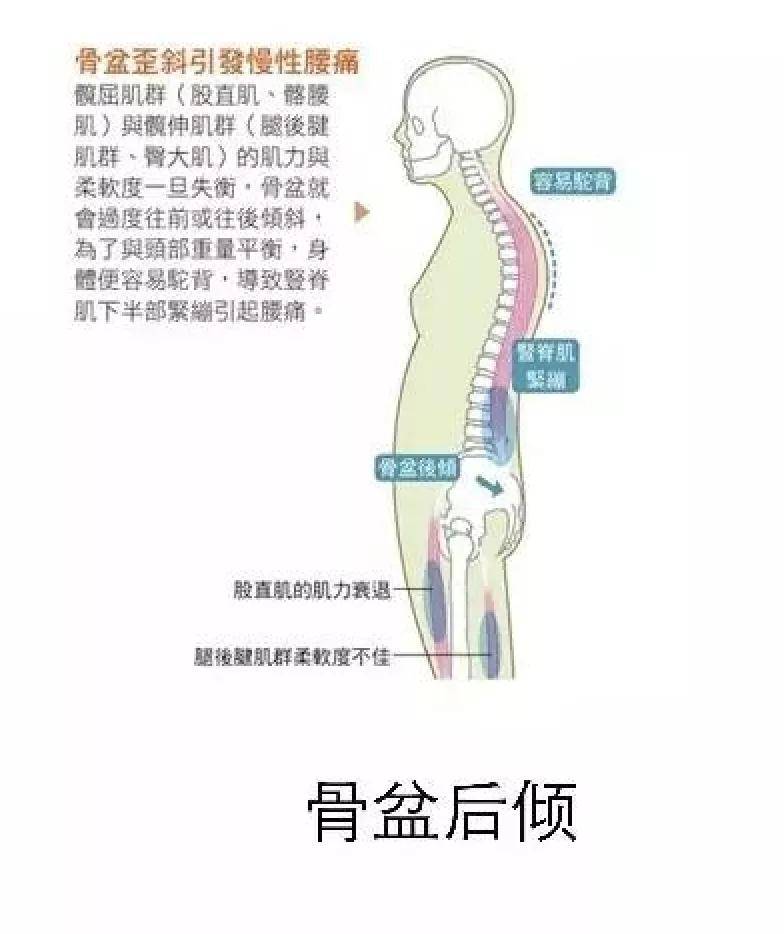 骨盆——人体"地基"不可倾斜