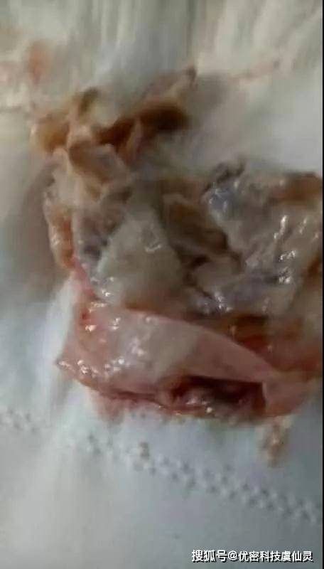 5,宫颈糜烂4,宫颈纳囊3,滴虫或者细菌性阴道炎2,霉菌性阴道炎