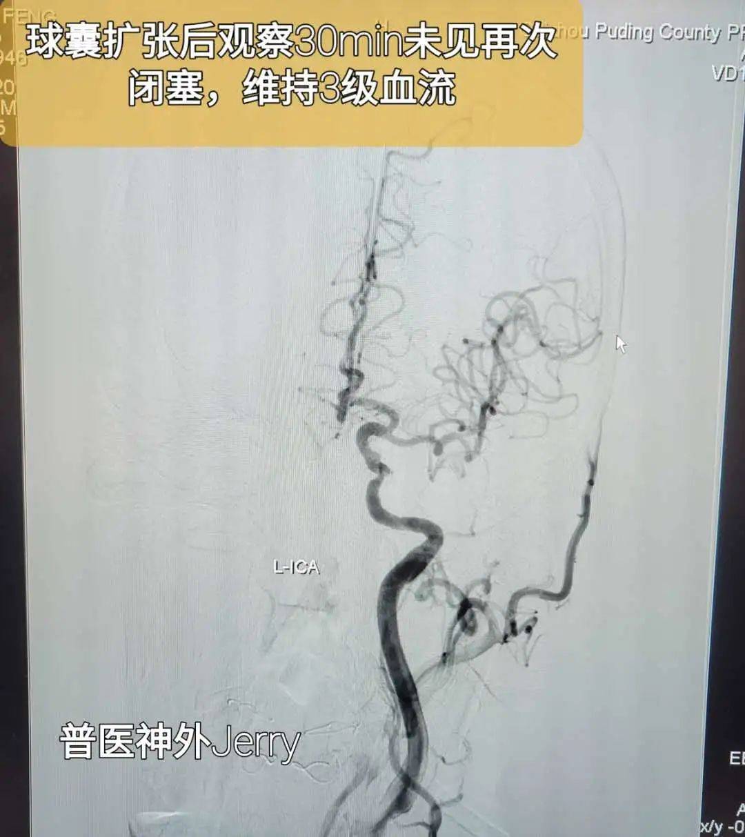 家属|卒中绿色通道，让生命跑过死神