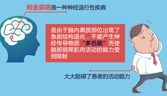 国内统计55岁以上人群中有帕金森病人170多万,患病10年后患者的死亡率