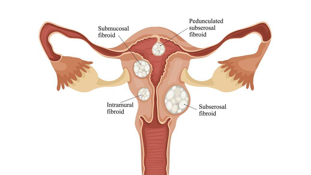 为什么子宫肌瘤会导致月经量多?