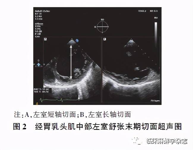 继续液体输注至容量过负荷,会导致左室心腔在舒缩末显著增加,甚至成