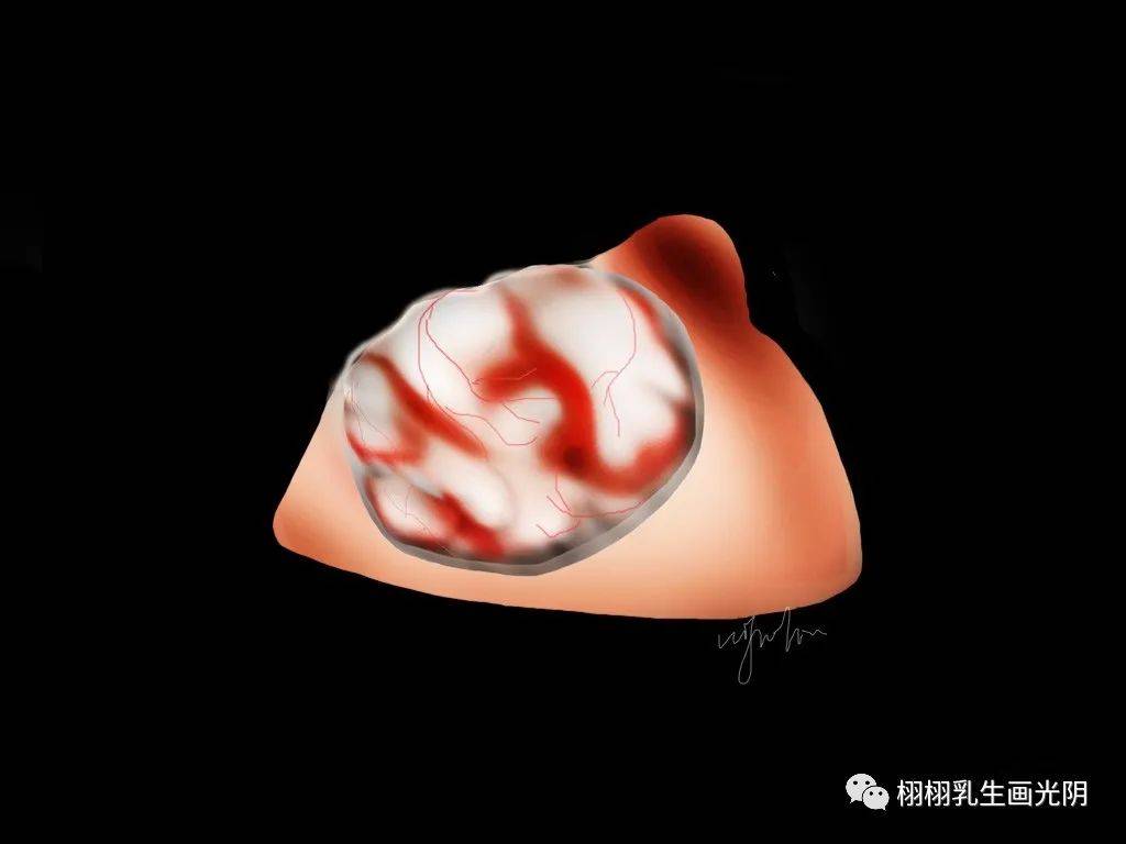 漂亮姑娘的尴尬,胸里长的"珍珠"-乳腺纤维腺瘤