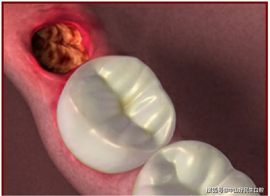 牙医教你 怎样预防干槽症