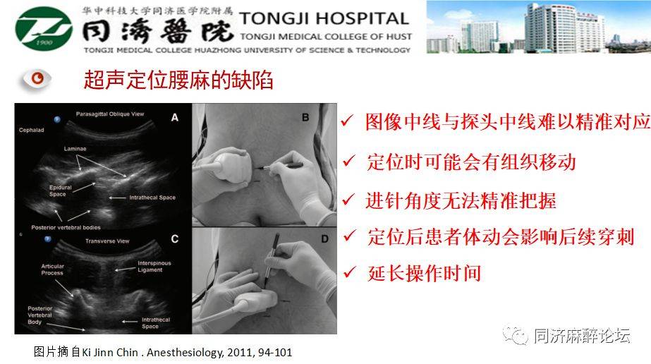 实时超声引导腰麻