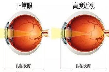 在眼睛结构上,高度近视与正常眼的区别在于眼轴过长.