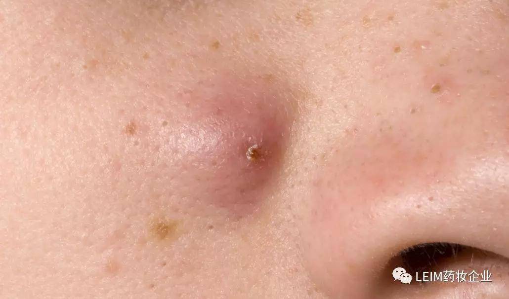 你脸上的"痘痘"到底是丘疹还是脓包,结节,囊肿?
