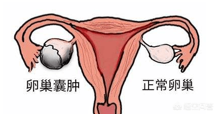 什么原因导致卵巢多囊 8168c6d628a44ab8b185d4a5c6312d82.png