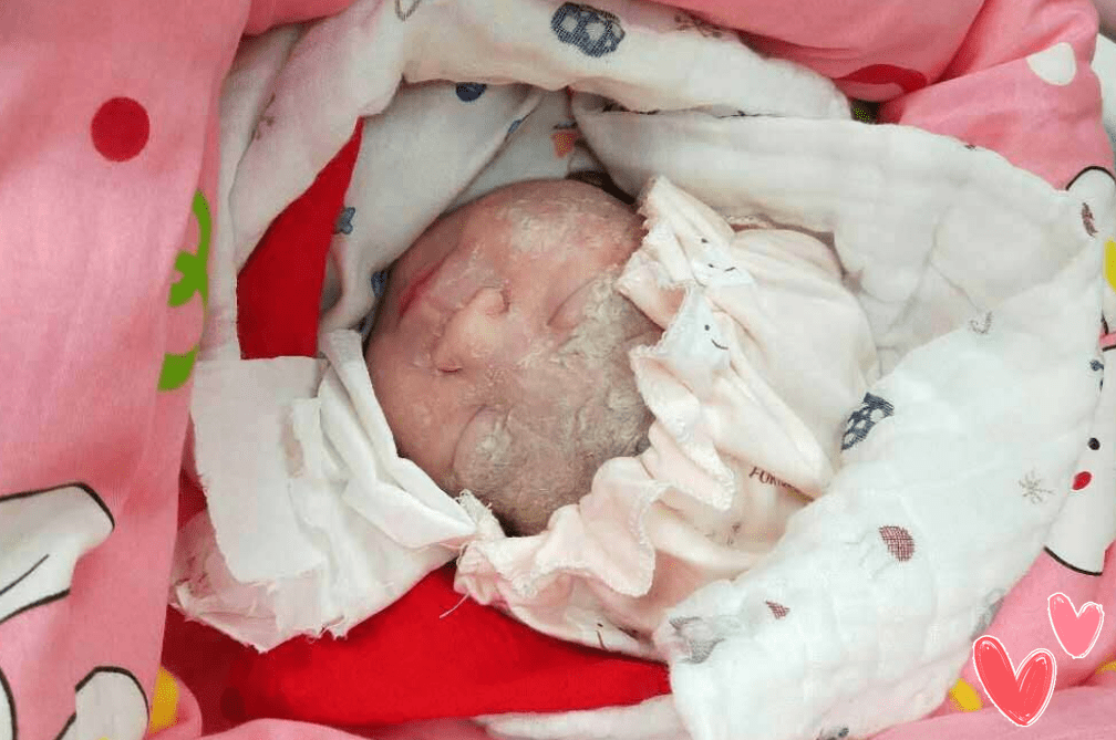 胎毛|新生宝宝胎脂胎毛该咋处理？父母须看“真丑！生了个毛娃娃”