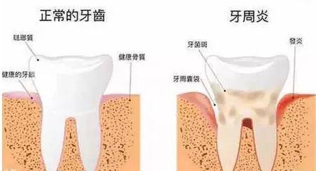 牙疼引起的发烧怎么办