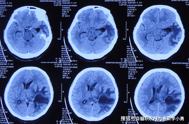 入院第13天即2018年11月4日,常规复查头颅ct示左颞脑脓肿较前减小,左