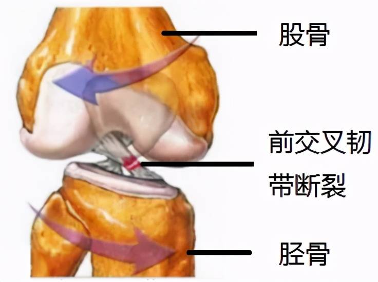 前交叉韧带断裂患者必须知道的几个知识