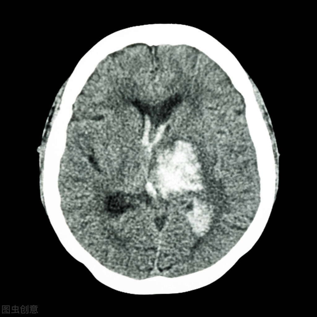 比如说脑出血,动脉瘤,动静脉畸形,蛛网膜下腔出血,脑梗死,脑缺血灶