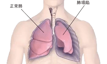 便会进入胸膜腔形成气胸 在气胸状态下 胸腔内气压升高 肺部收缩造成