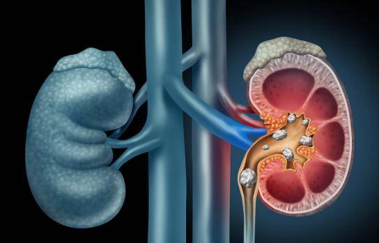 肾结石是属于什么病 814f0805e98d49e3afa7448f74c63dd8.jpeg