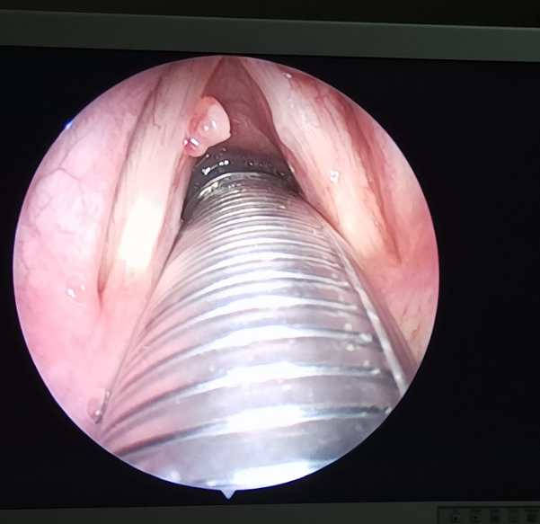 贵阳铭仁耳鼻喉医院科普:声带息肉严重吗?小心,不及时