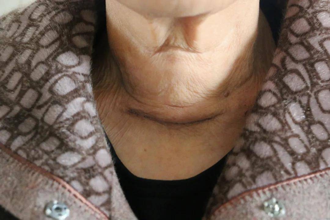 上虞第三医院双侧甲状腺乳头状癌全切术成功开展