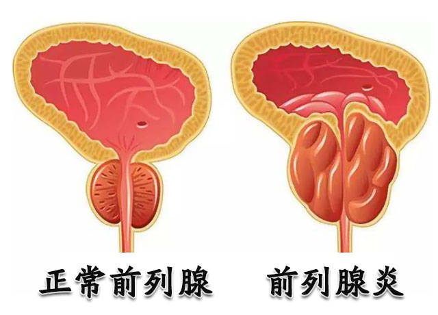 从中医角度对慢性前列腺炎剥茧抽丝!辩证分型论治慢性