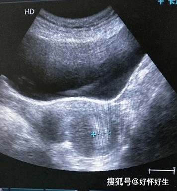 子宫内膜薄怎么调理恢复快一点（子宫内膜薄怎么调理吃什么）-85模板网