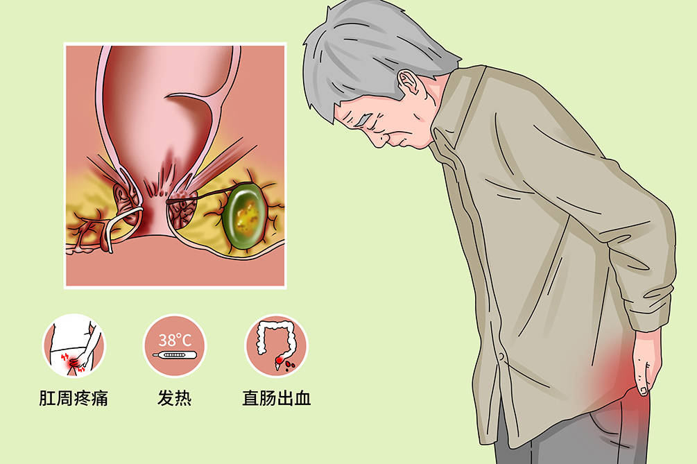 肛瘘形成需要经过四个阶段想要治愈如何截住发展是关键