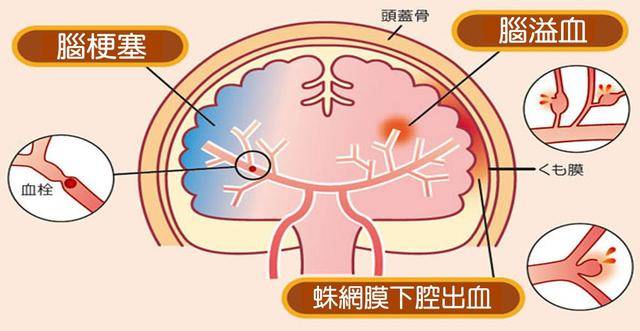吃什么能消除脑雾 a0b5aa218804419b87abab2ad5f76c87.jpeg