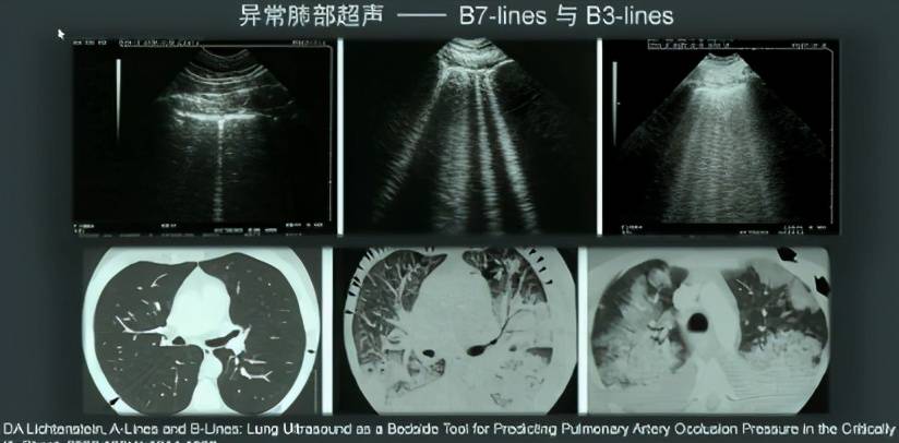 重症超声在创伤麻醉中的应用-肺部重点超声检查