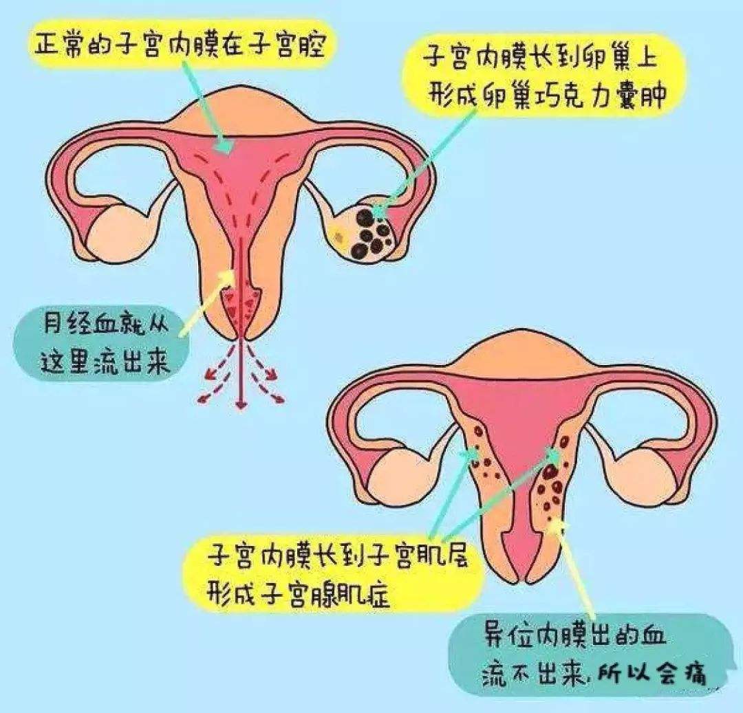 子宫腺肌病有什么症状?